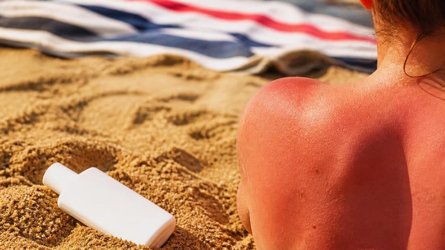 Levensgevaarlijk: 1 op de 5 zonaanbidders weigert zonnebrand voor een sneller kleurtje